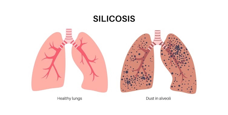 A diagram of a healthy pair of lungs, alongside a pair of lungs affected by silicosis.