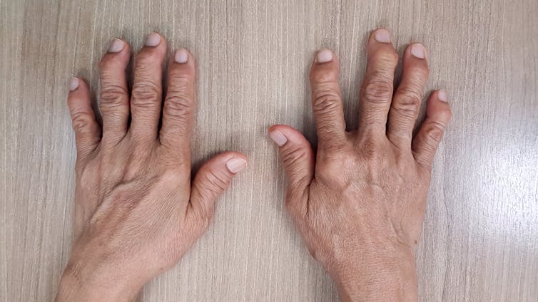 Pair of hands laying flat with bent joints in the fingers.