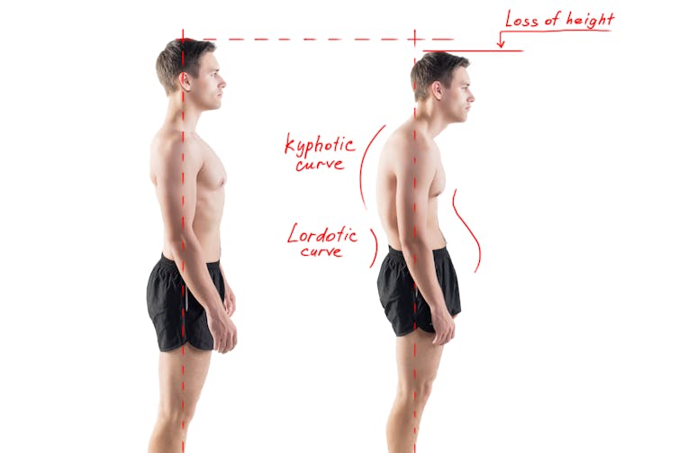 Man with impaired posture position
