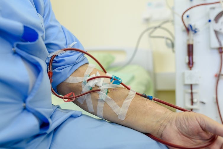 Person having dialysis in hospital, with dialysis catheter connected to vein